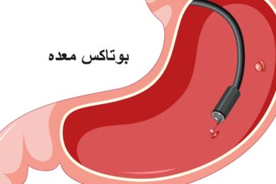 بوتاکس معده