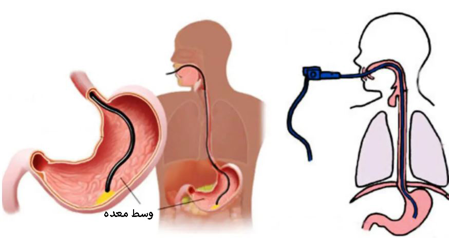 نحوه عمل بوتاکس معده