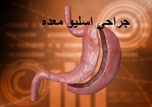 عمل اسلیو معده